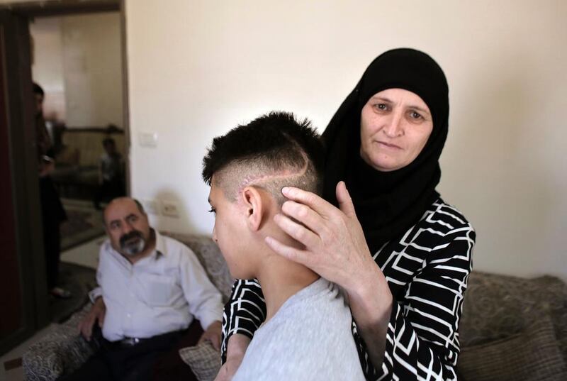 The mother of Palestinian teenager Ahmed Abu Al Homs shows a scar on her son's head at their home in east Jerusalem on April 7, 2016. The picture was taken a few months after Ahmed was wounded by sponge-tipped bullets. Ahmad Gharabli/AFP


