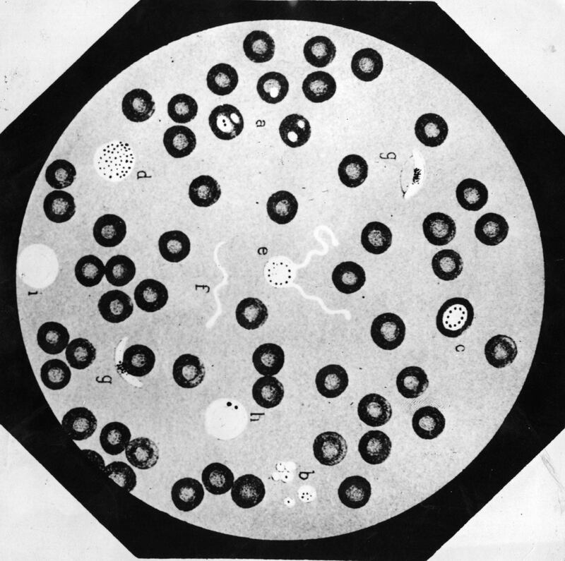 FOR MALARIA / SMALPOX GALLERY. circa 1893:  A view through a microscope of fresh blood, possibly infected with malaria.  (Photo by Hulton Archive/Getty Images)