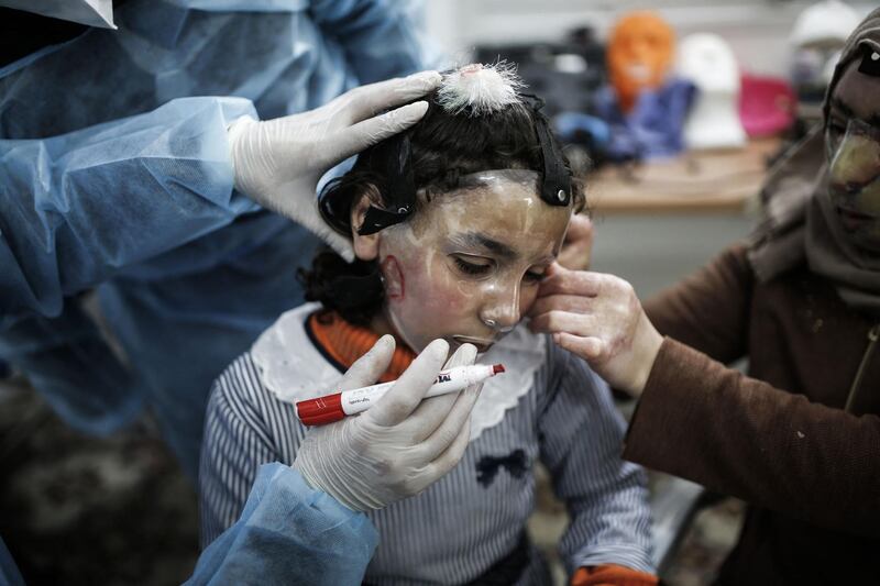 Palestinian Maram and her mother Izdihar al-Amawi suffering from severe facial burns get fitted with a 3D-printed transparent face mask at a clinic run by the Doctors Without Borders (Medecins Sans frontieres - MSF) international healthcare charity in Gaza City, on February 22, 2021. Severely burned a year ago in an inferno caused by a gas leak, authorities said, in the Palestinian refugee camp of Nuseirat in the central Gaza Strip, Maram and her mother Intizar wear transparent 3D-printed plastic masks developed by the Doctors Without Borders (Medecins Sans frontieres - MSF) international healthcare charity, which put pressure on the face and advance the healing process, the NGO representative in Gaza said. / AFP / Mohammed ABED
