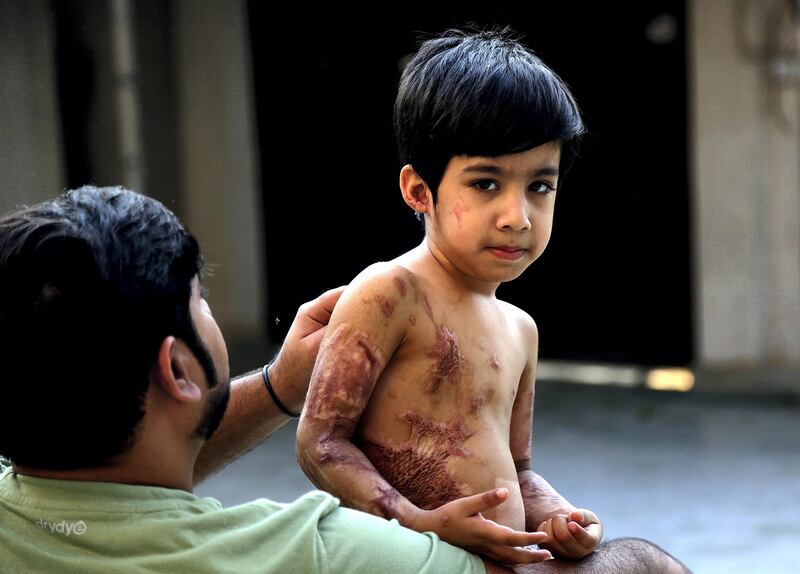Dubai, 10, Nov, 2017: Abdul Rehman a four year old who has the third degree burns seen with his father Mohammed Umer Iqbal at his residence  in Dubai. Satish Kumar for the National / Story by Shereena Al Nuwais 