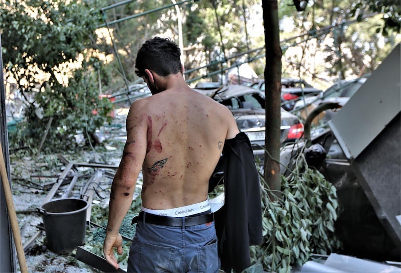 A Lebanese man shows injuries on his back after the massive explosion in Beirut.  EPA