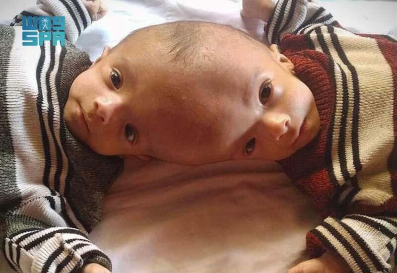 Yemeni conjoined twins Yousuf and Yassin. SPA
