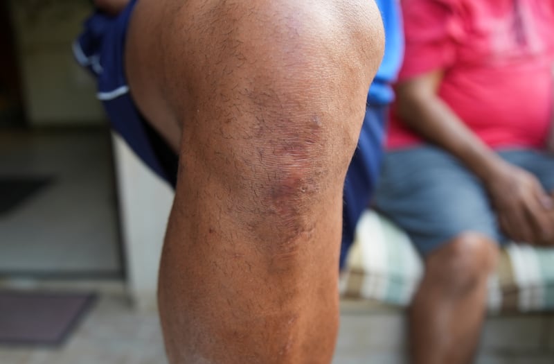 Lebanese trainer Ramzi Baaklini shows a scar on his knee from last year's Beirut port blast, in Baabda, Lebanon.