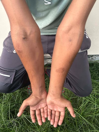 A 35-year-old male inmate at Navjeevan Kendra shows multiple marks from injecting heroin.