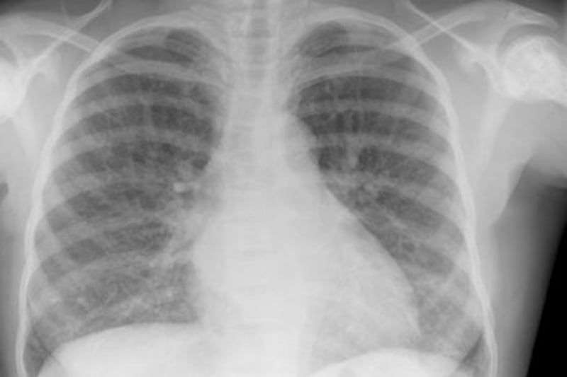 Typical findings on a chest X-ray in sickle cell disease, show a slightly enlarged heart. iStockphoto