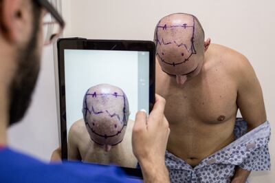 A patient has his photograph taken before undergoing a robotic hair transplant procedure in Istanbul, Turkey. Getty Images