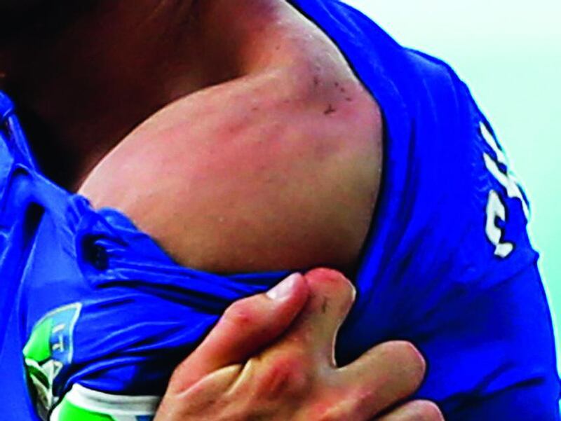 Italy’s Giorgio Chiellini shows teeth marks on his shoulder where he was bitten by Uruguay’s Luis Suarez, during their 2014 World Cup match at the Dunas arena in Natal in this June 24 photo.  Tony Gentile / Reuters