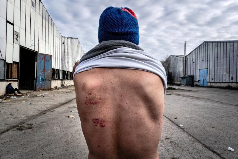 202002, Kristof Vadino, Bosnia, refugees,, migrant shows his wounds inflicted by Croation police, it is called 'The Factory', and is probably the biggst squad with very bad hygienic conditions, he came back from the border 2 days before