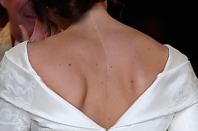 TOPSHOT - The scar on the back of Britain's Princess Eugenie of York is clearly visable as she arrives for her wedding to Jack Brooksbank at St George's Chapel, Windsor Castle, in Windsor, on October 12, 2018. / AFP / POOL / TOBY MELVILLE
