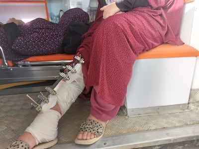 Rahma Abu Herbeid shows her injured right leg, which Gaza's overstretched hospitals are unable to treat properly. Photo: Mohamed Soleiman