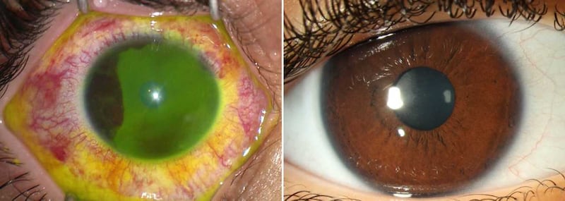 Getting sanitiser in your eye can lead to chemical burns
