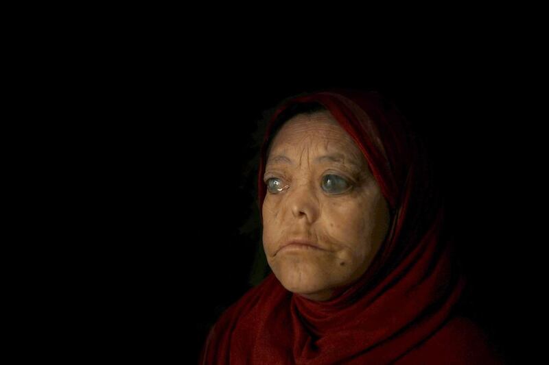 A leprosy patient sits inside her room at the leprosy hospital in Srinagar, the summer capital of Indian Kashmir. Farooq Khan / EPA