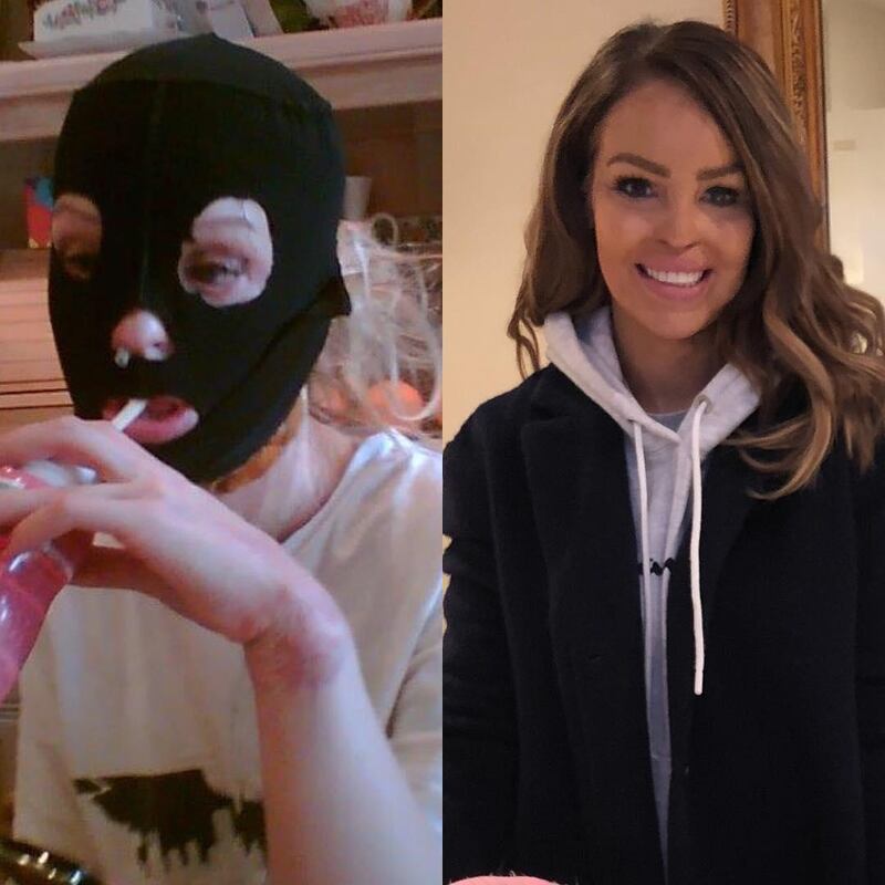 Katie Piper, the survivor of a 2008 acid attack, shared an affecting #10YearChallenge post on her social media platforms. Instagram
