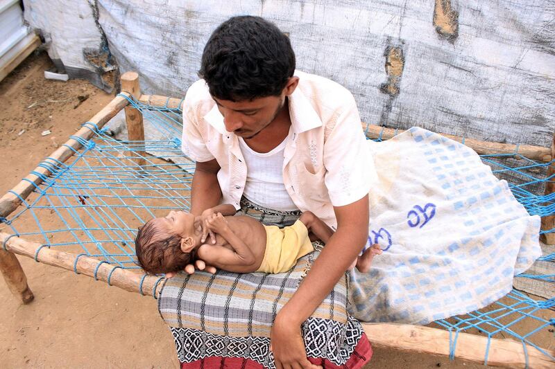 Yemeni child Meshaal Mohammad, a four-year-old weighs nine kilogrammes due to acute malnutrition, sleeps in his father's lap at a camp for the internally displaced in Yemen's northern Hajjah province on March 2, 2021. Famine could become part of war-torn Yemen's "reality" in 2021, the UN warned, after a donor conference raising funds to keep millions from starvation fell short by over half.
The United Nations had sought Monday to raise $3.85 billion from more than 100 governments and donors, but only $1.7 billion was offered. / AFP / ESSA AHMED
