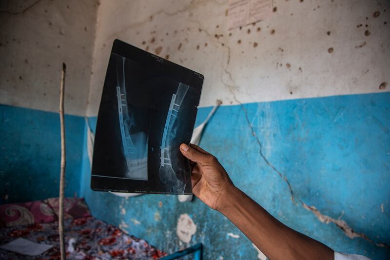 Khalifa Ibrahim shows an image of his X-ray at the camp. Getty