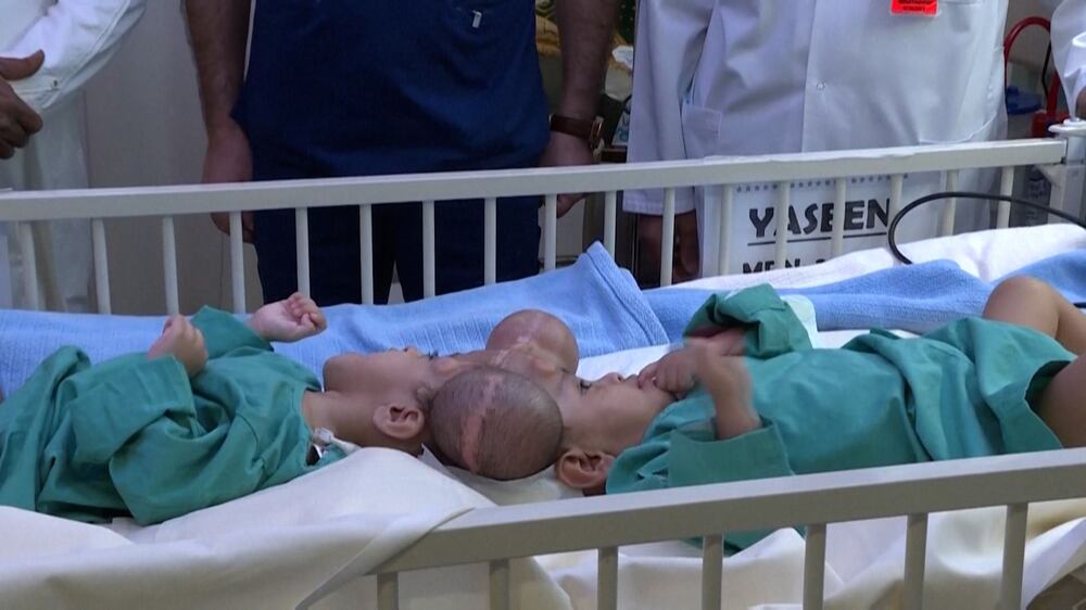 Conjoined twins successfully separated at a Saudi Arabian relief centre