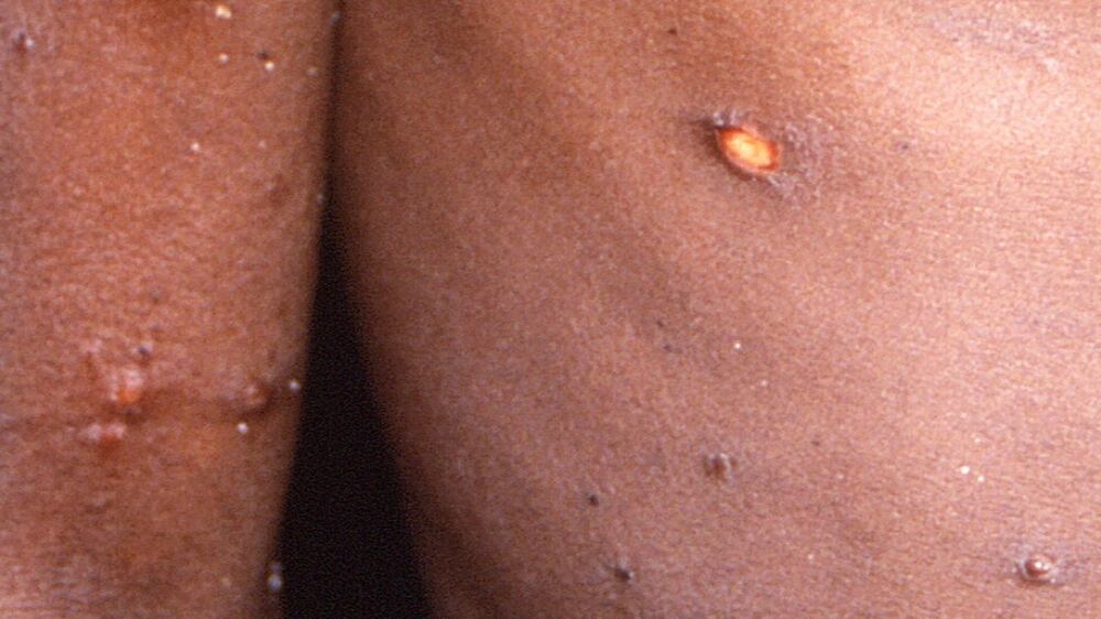 Monkeypox: everything you need to know