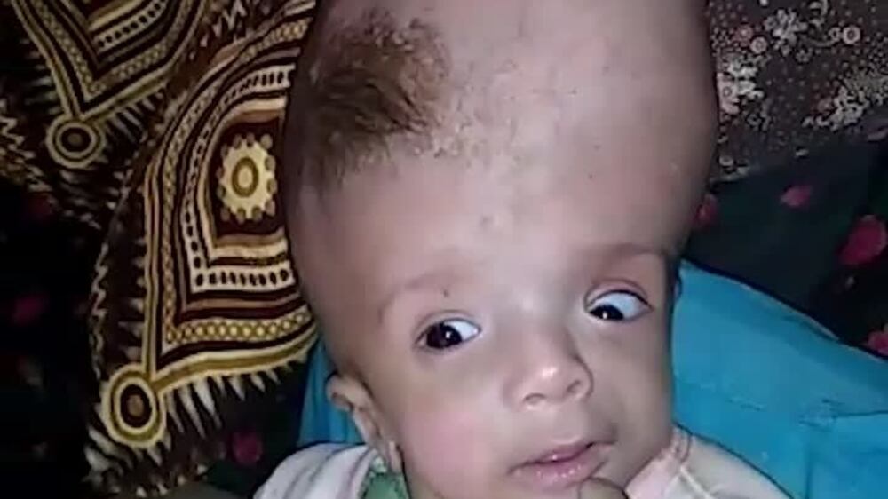 Conjoined Yemeni twins' family appeals for help