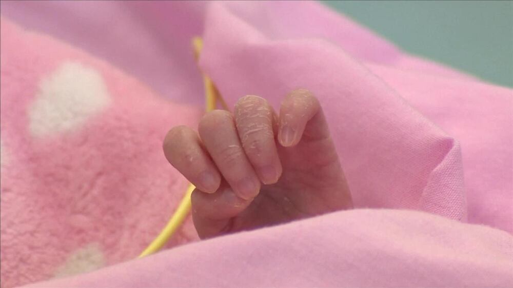 Newborn  with heart outside chest survives surgery in UK