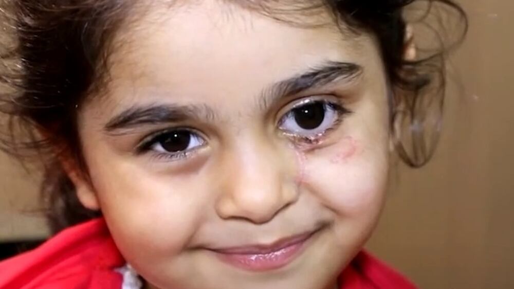 Syrian girl who lost an eye in Beirut blast given prosthetic by UAE