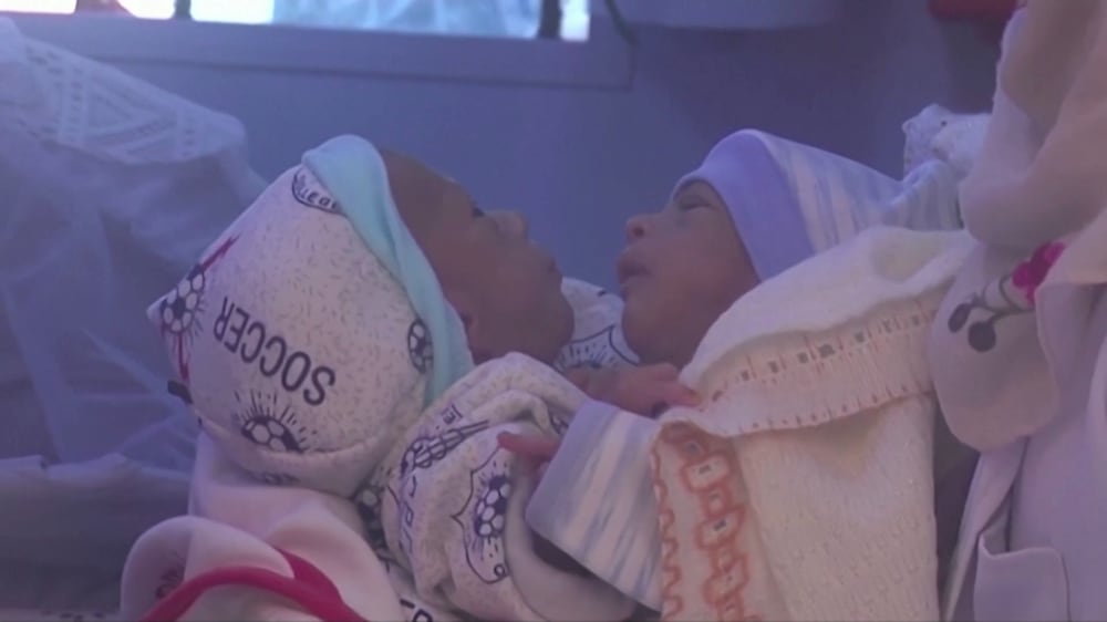 Doctors separate conjoined Yemeni twins