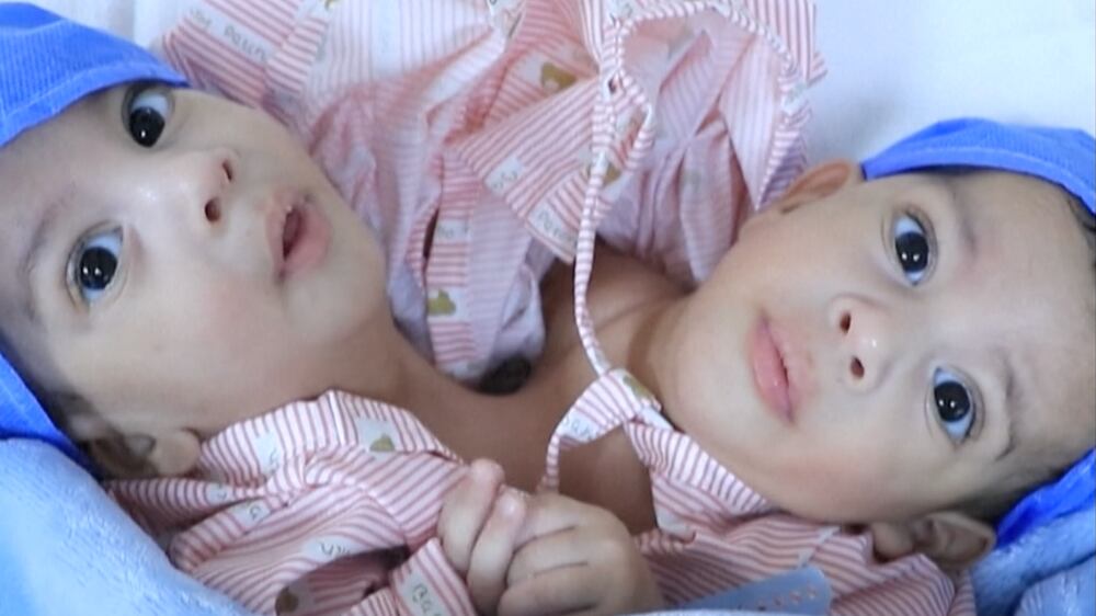 Separated conjoined twins return home to Yemen from Jordan