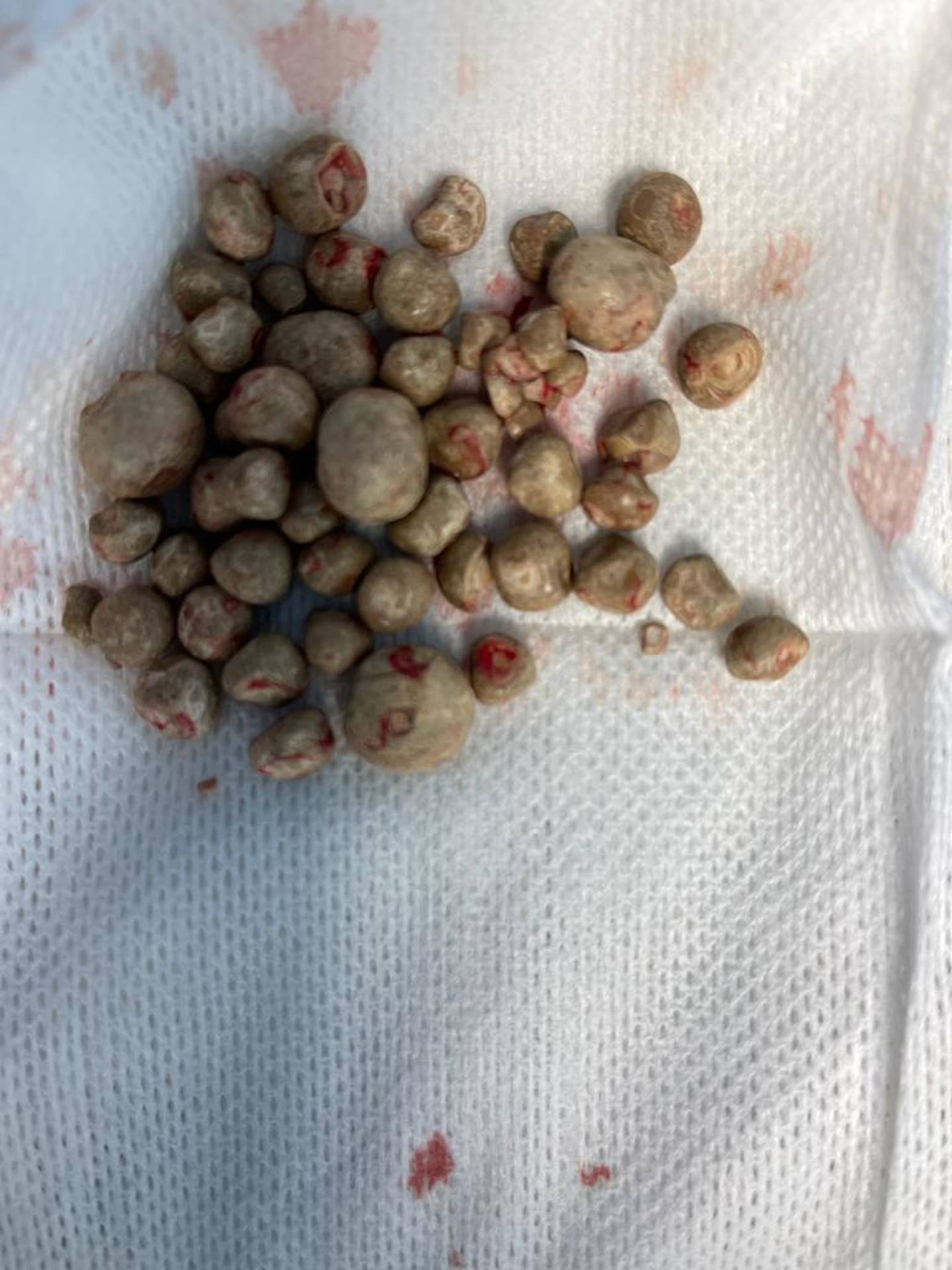 Burjeel Hospital's doctors have never seen a patient with so many bladder stones. Photo: Burjeel Hospital