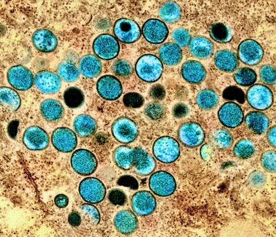 Monkeypox particles, here stained teal, found within an infected cell. PA